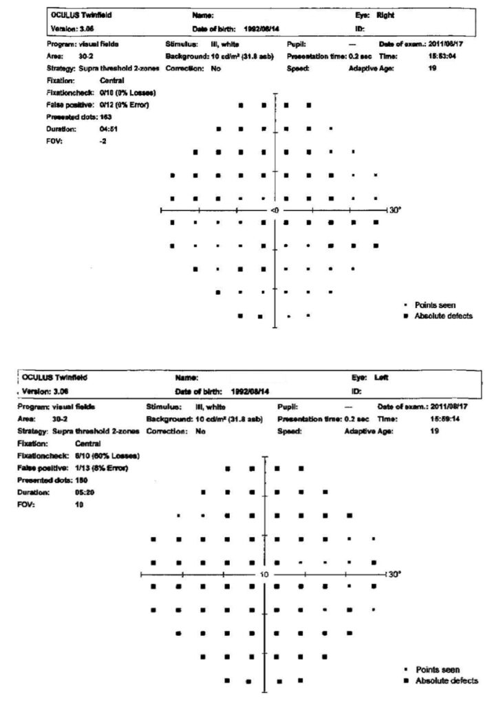 Visual field test results display from M&S VR Headset