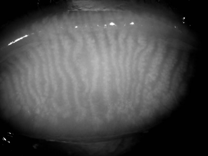 Infrared meibography image showing meibomian gland structure