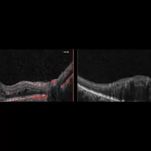 Solix Essential OCT side perspective