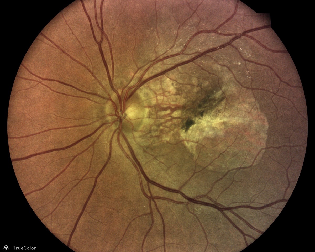 TrueColor fundus image showing age-related macular degeneration