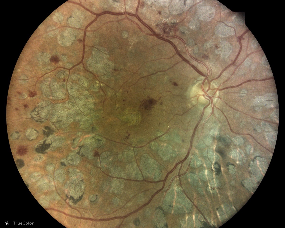 TrueColor fundus image showing diabetic retinopathy