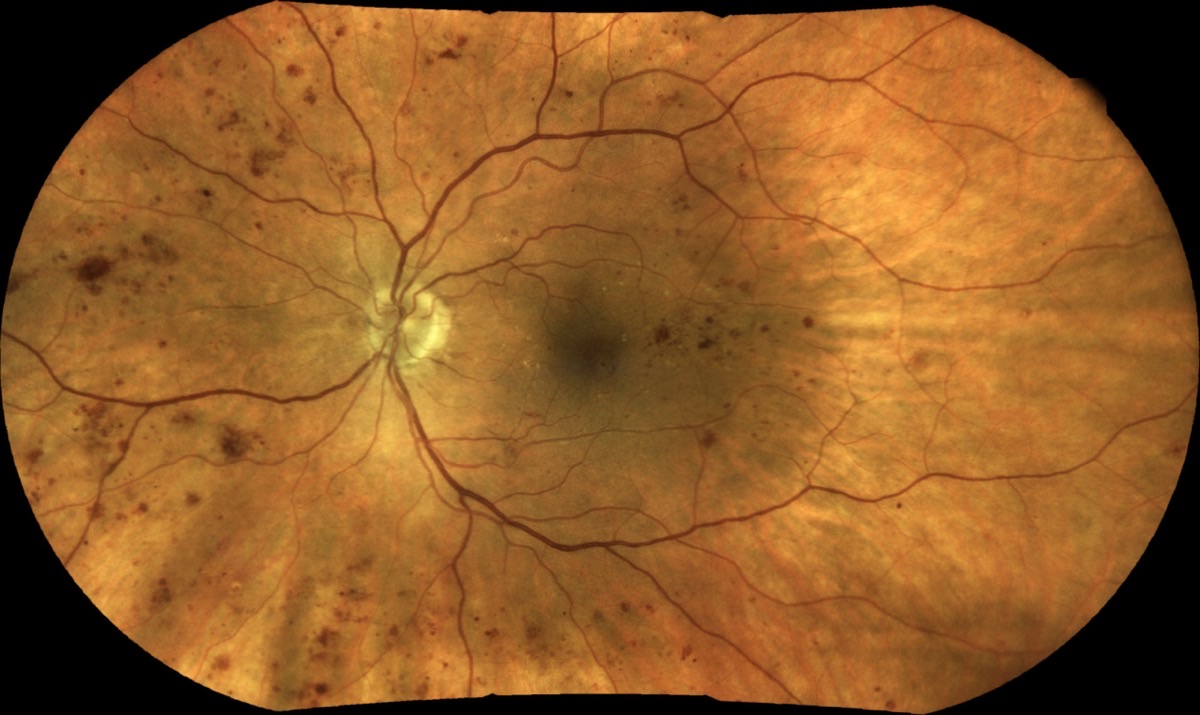200-degree TrueColor mosaic showing diabetic retinopathy