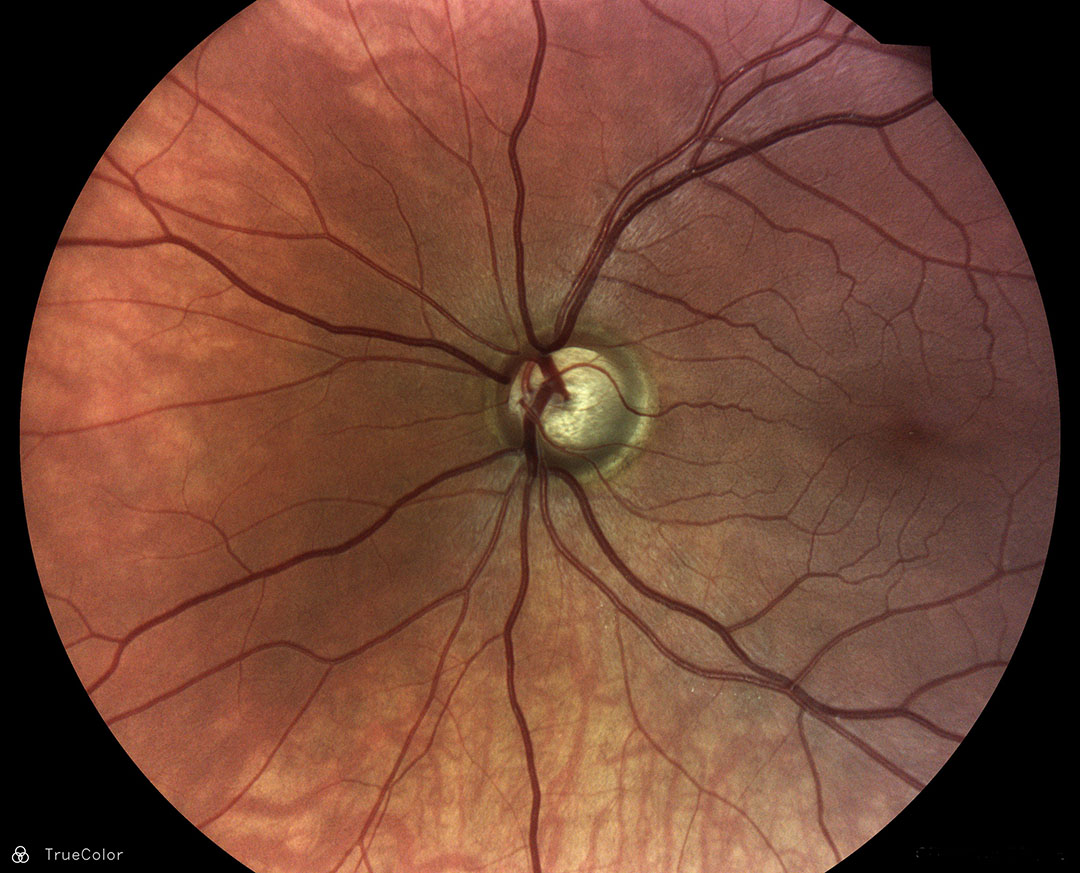 200-degree TrueColor mosaic showing glaucomatous optic nerve