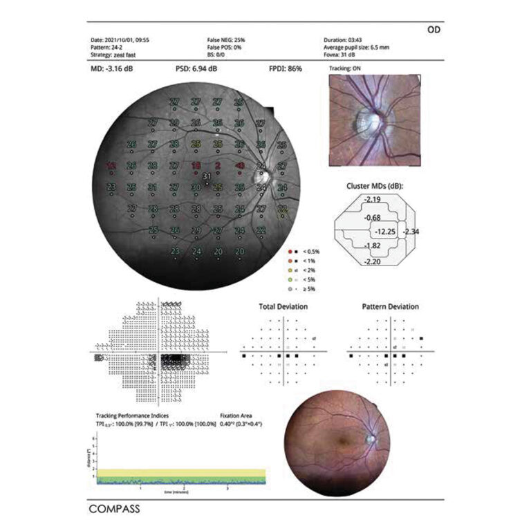 COMPASS visual field report with integrated fundus image
