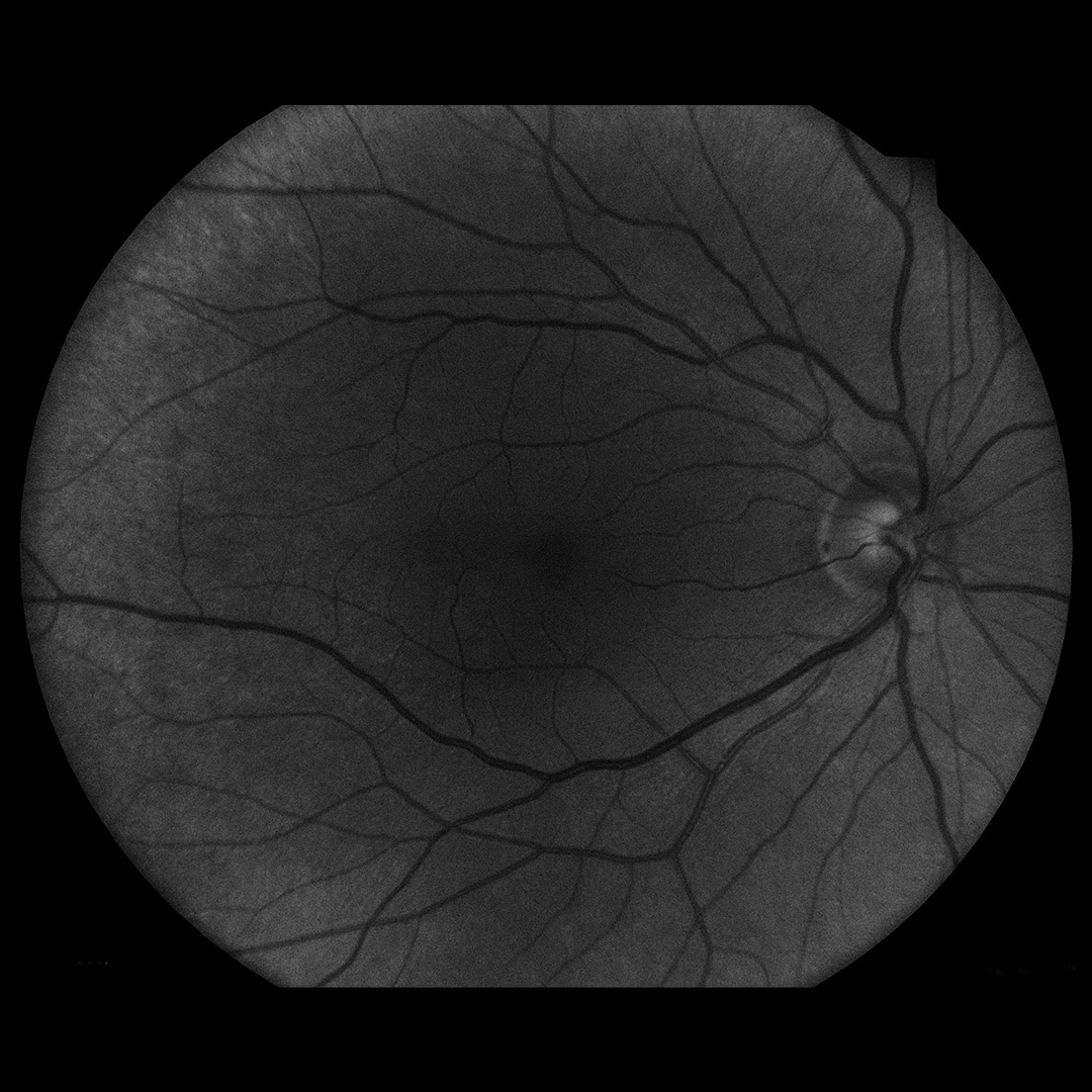 Blue imaging modality for RNFL