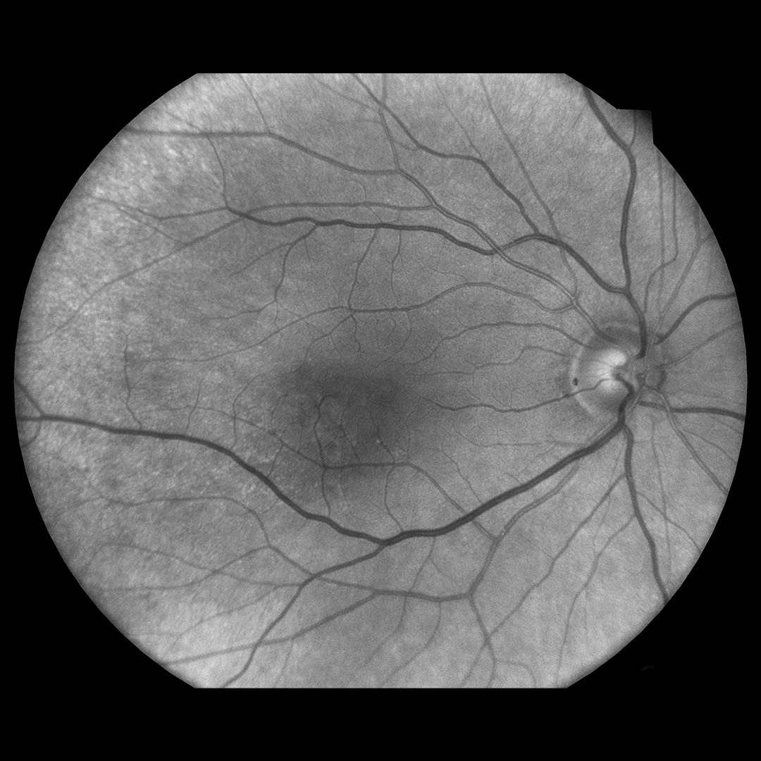 Red imaging modality for deep layers