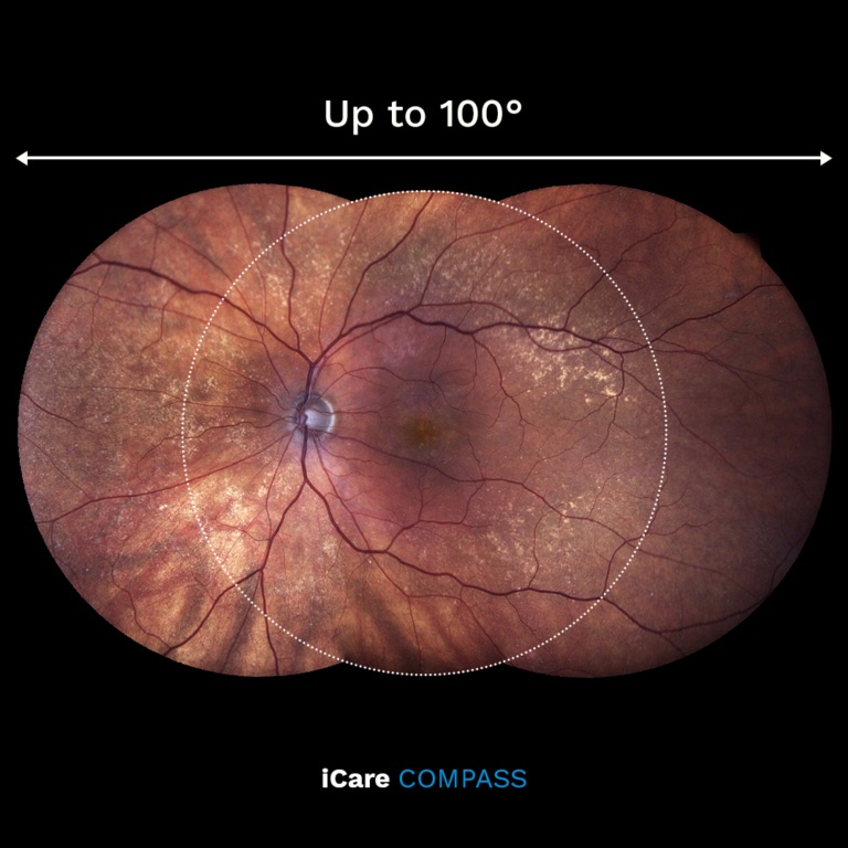 COMPASS SmartMosaic panoramic fundus image