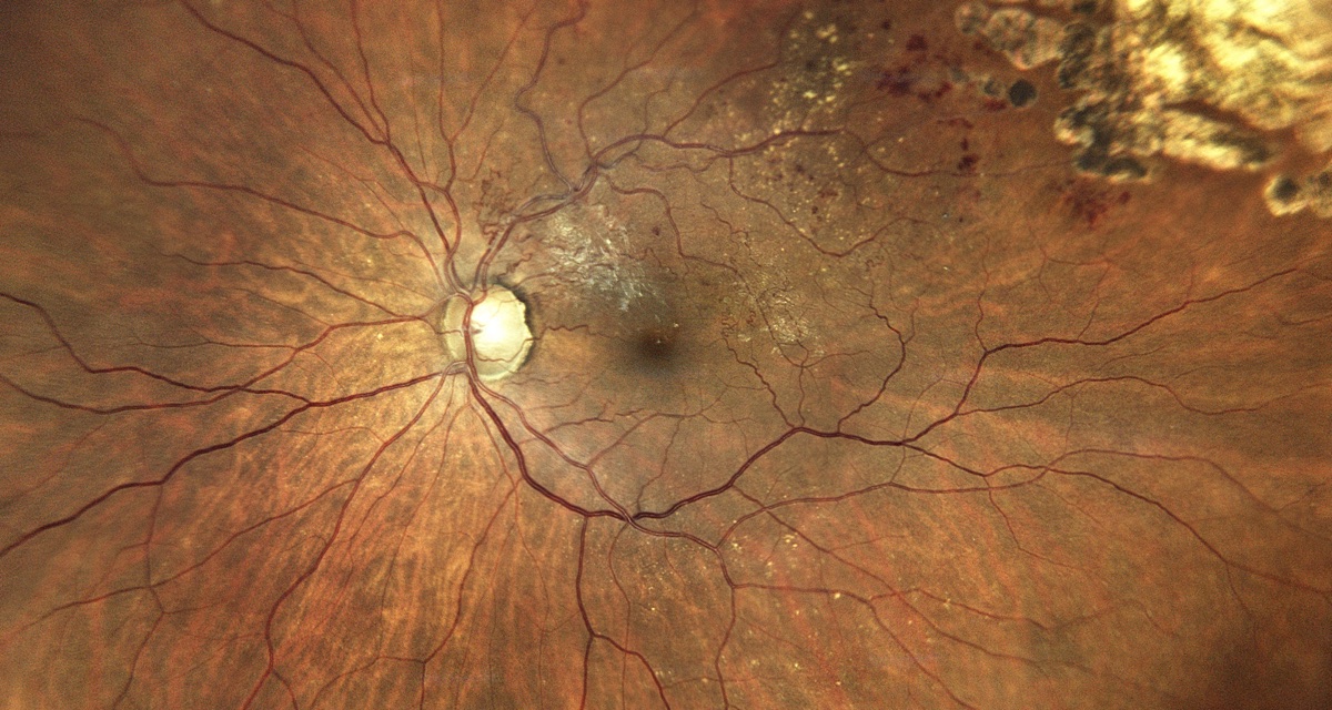 iCare EIDON UWF Retinal Imaging