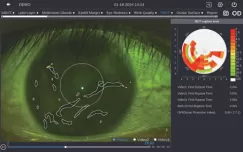 Tear Film Breakup Time