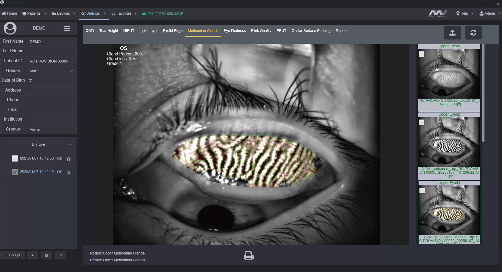MediView meibomian gland analysis interface showing gland loss assessment
