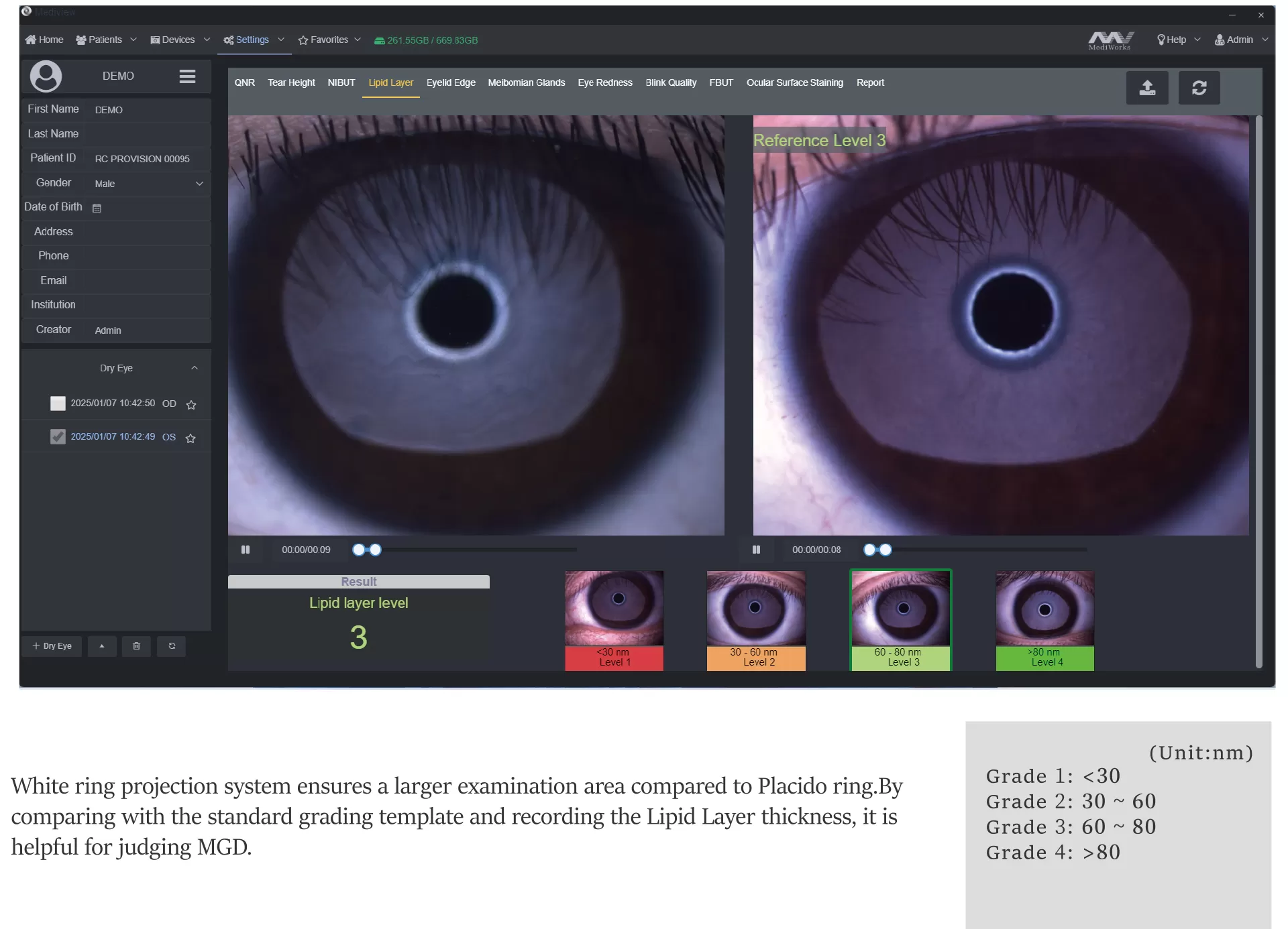 Lipid layer thickness analysis from MediView dry eye workup software