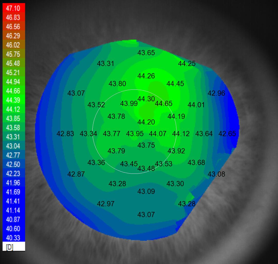 Placido-ring corneal topography map showing curvature data