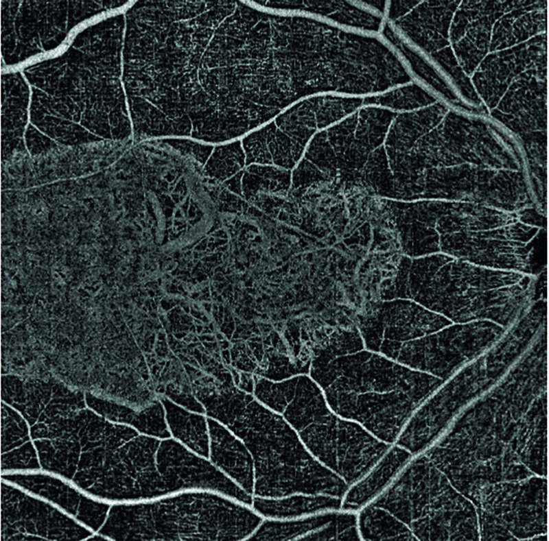 AngioVue OCTA scan of superficial retinal vasculature, 9x9mm field