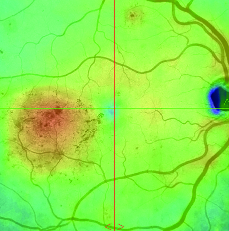 Retinal thickness map showing macular thickness measurements